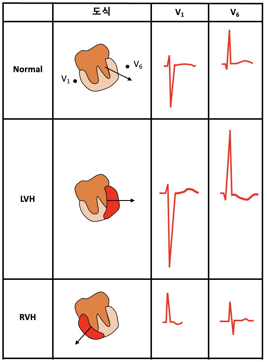 심장 비대(Enlargement/hypertrophy) | 메디톡