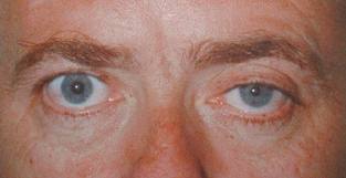 Horner's Syndrome - Physiopedia