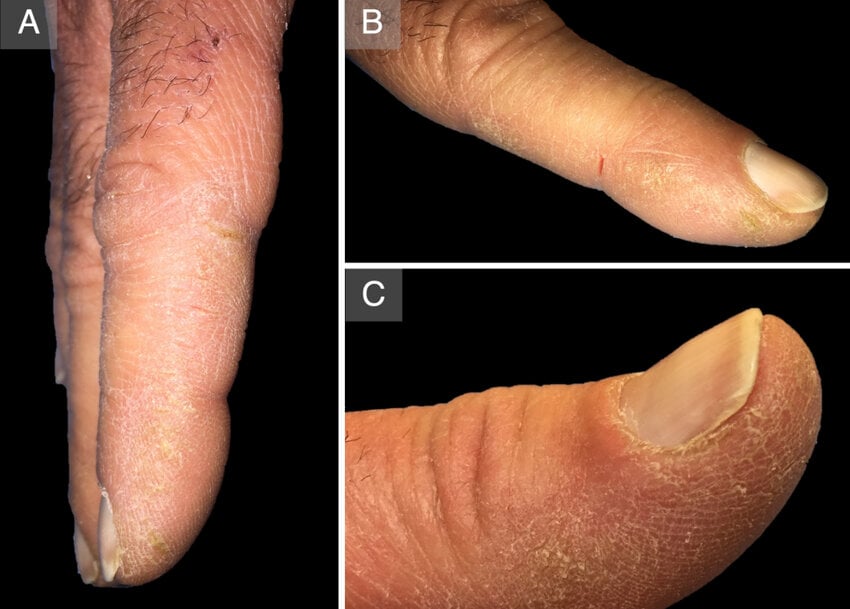 Mechanic's hands. A: Hyperkeratosis on the distal and lateral aspects of the index finger of the right hand. B: A fissure on the lateral side of the index finger of the left hand. C: Detail of the hyperkeratosis on the medial aspect of the thumb of the right hand.