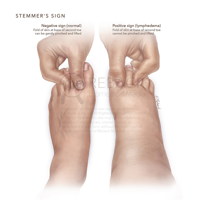 Stemmers sign Illustration by Nicholas Reback | Medical Illustration &  Animation