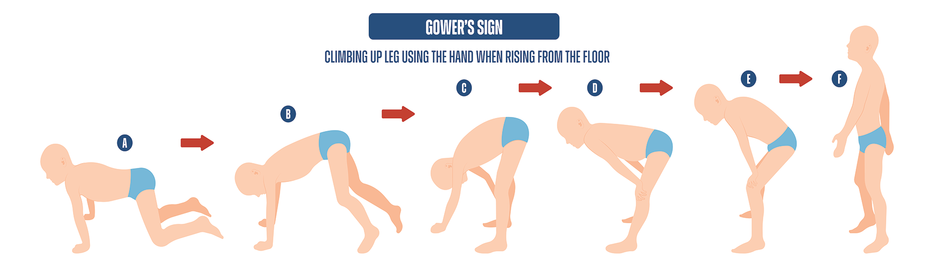Image depicting Gower's sign