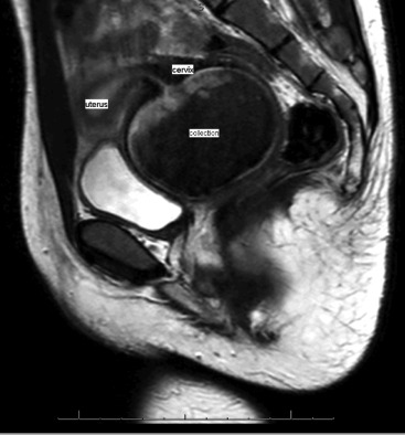 Adolescent With Concomitant Transverse and Longitudinal Vaginal Septa -  ScienceDirect