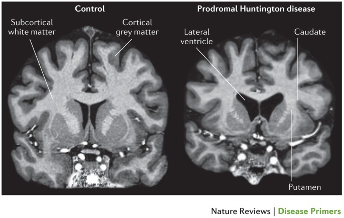 Huntington disease | Nature Reviews Disease Primers