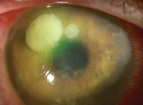 Understanding Corneal Infection Care