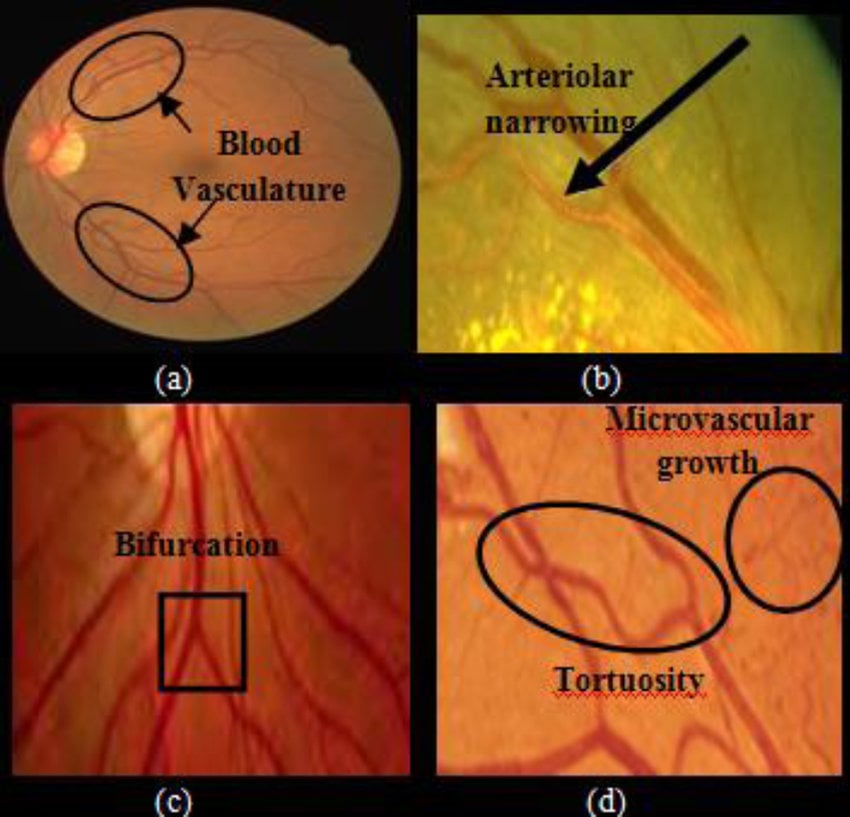 a) Healthy retinal fundus image; (b) retinal fundus image showing... |  Download Scientific Diagram