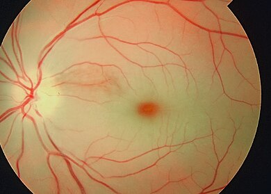 Central retinal artery occlusion - Wikipedia