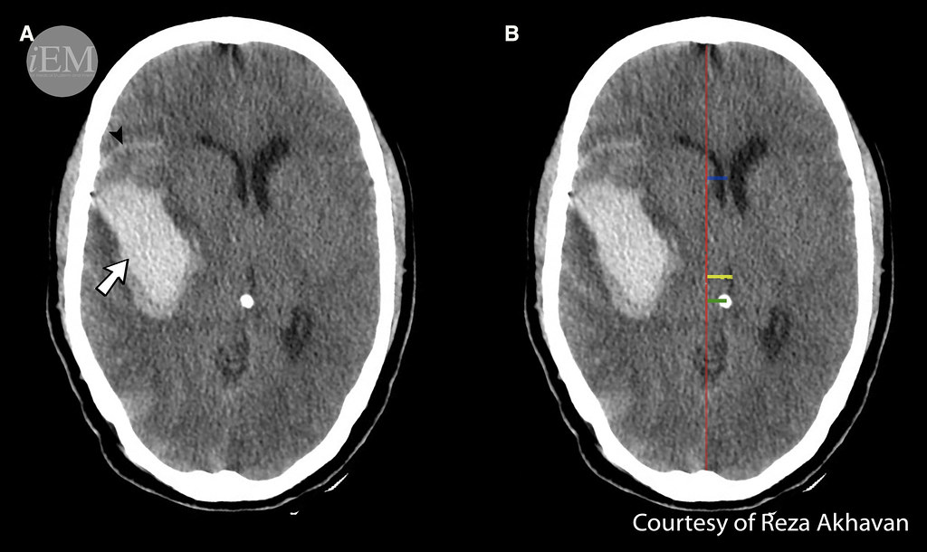 627.3 - Figure 03 - ICH in the right parietotemporal lobe | Flickr