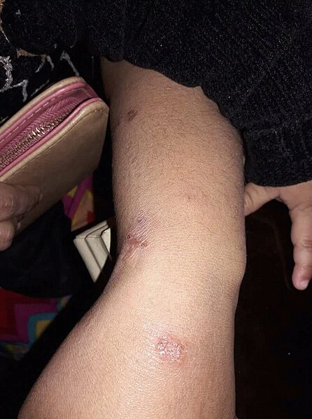 File:Discoid eczema.jpg
