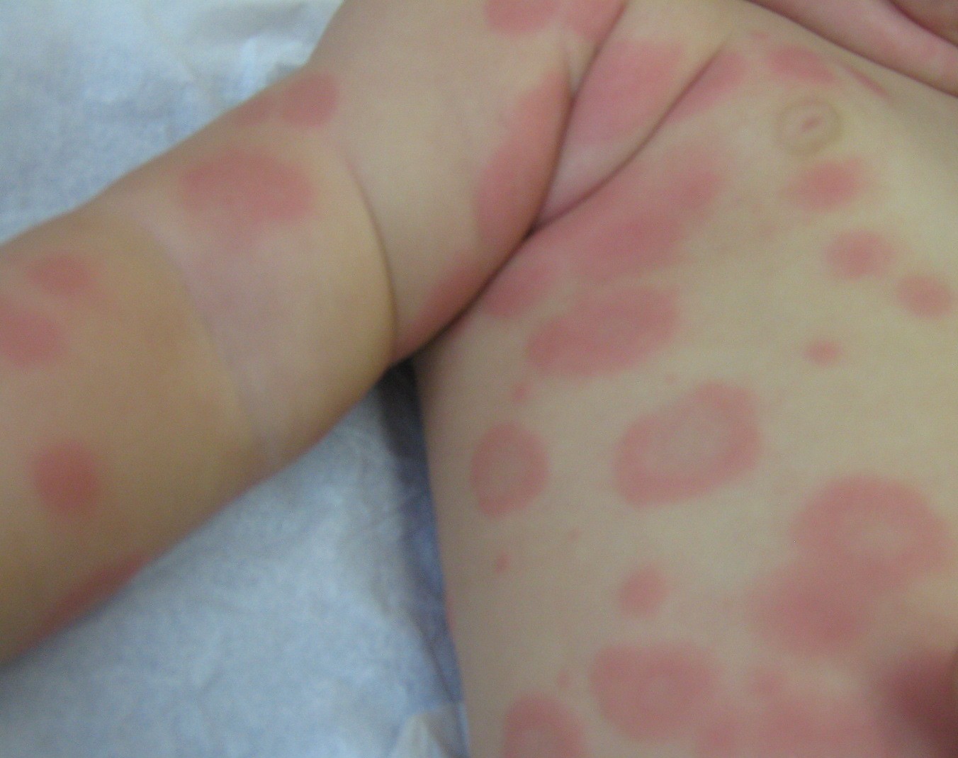 File:Erythema multiforme EM 02.jpg - Wikimedia Commons