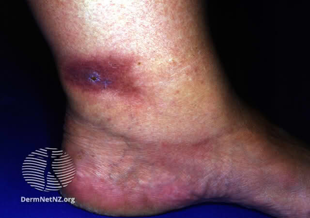 erythema induratum – Store medisinske leksikon