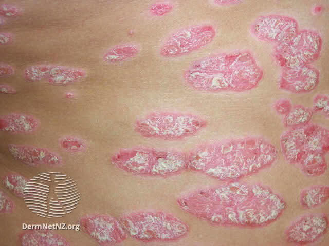 psoriasis – Store medisinske leksikon