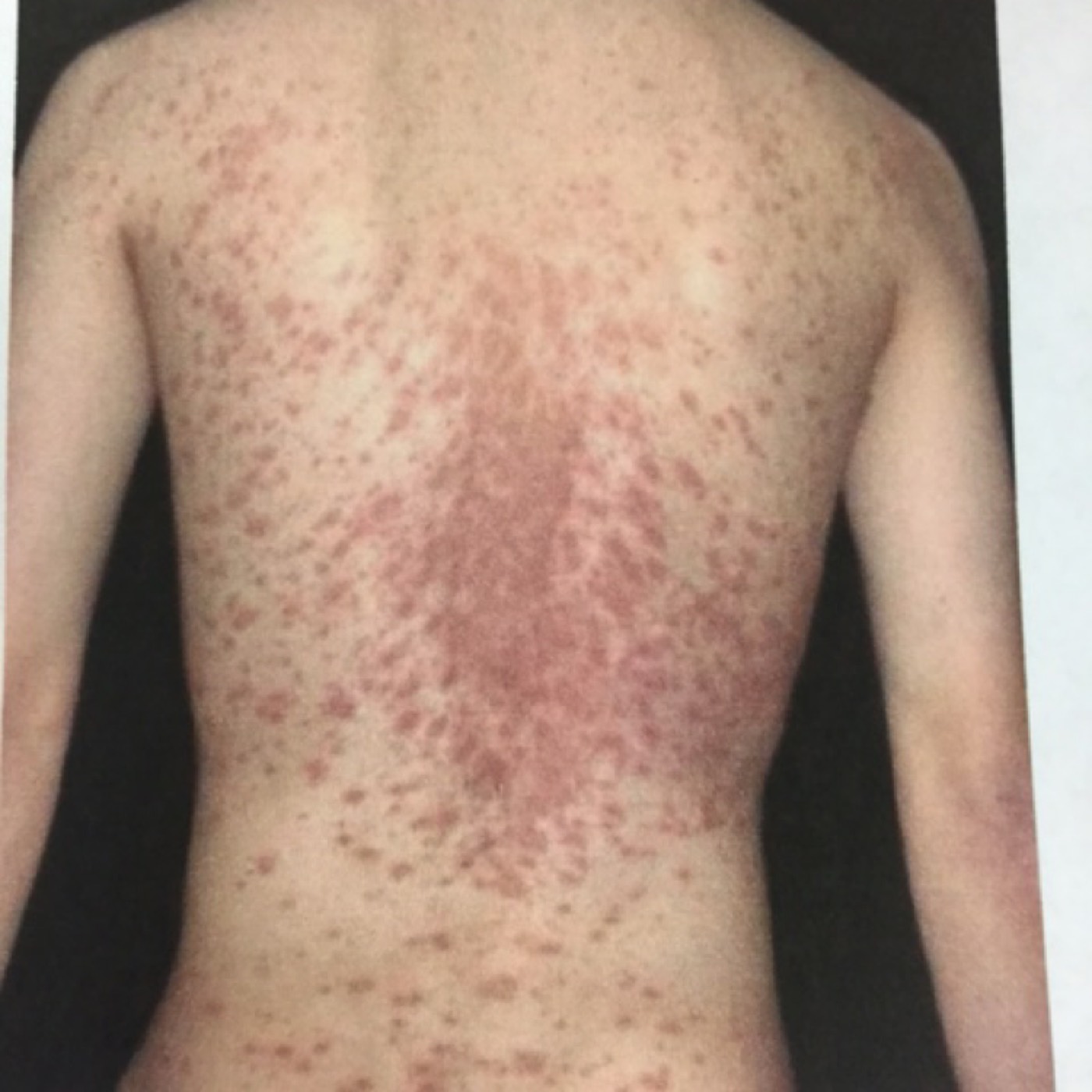 Podcast #71: Pityriasis Rosea - The Emergency Medical Minute
