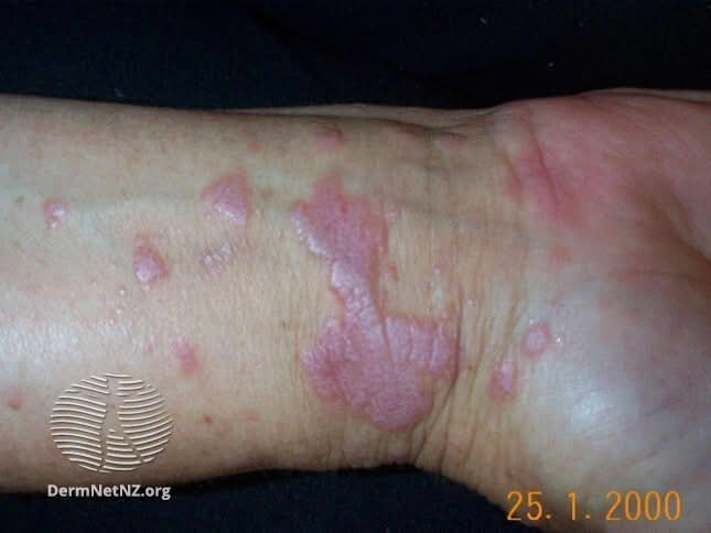 lichen planus – Store medisinske leksikon