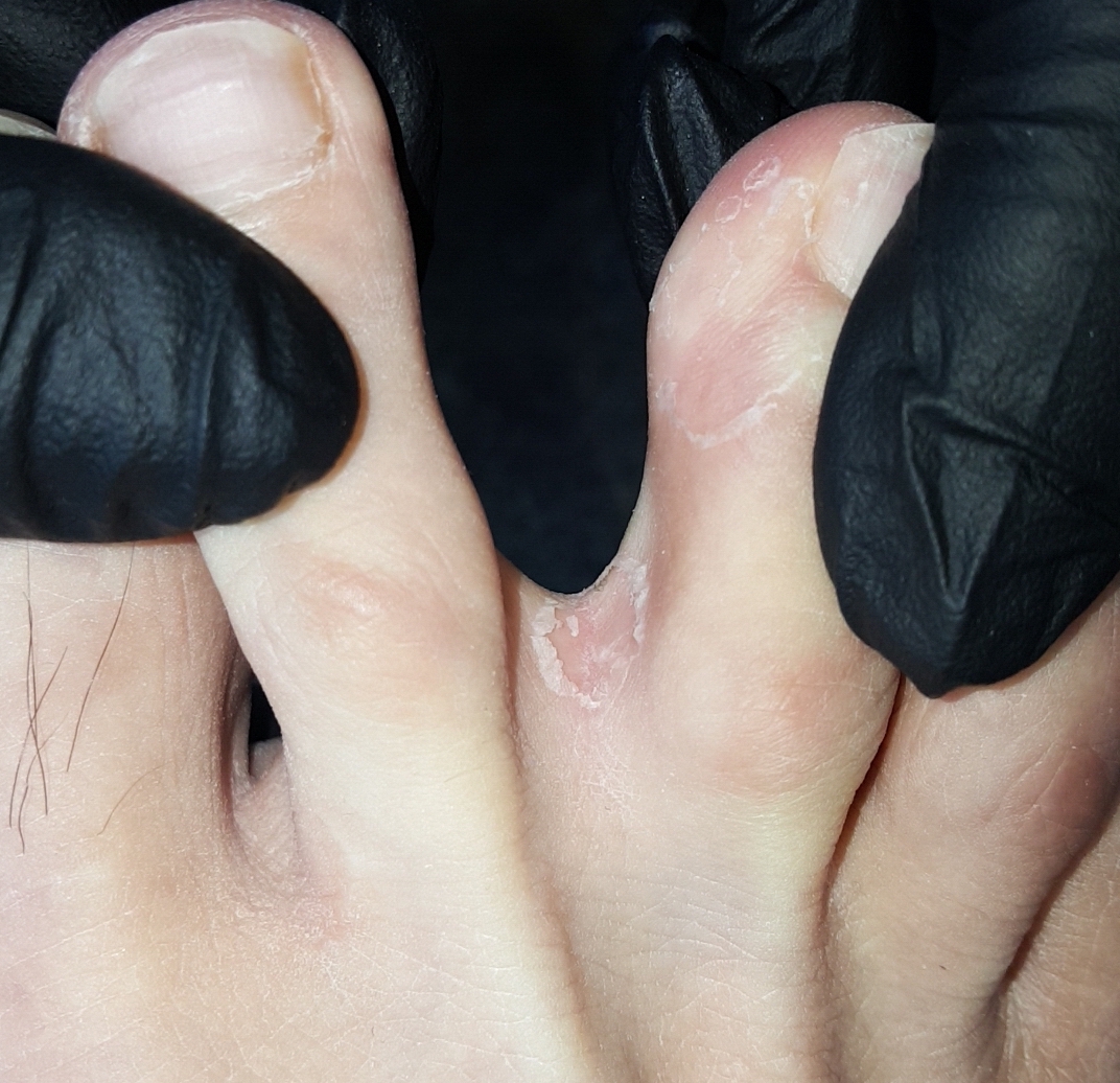File:Tinea-pedis-interdigital-Sean.jpg - Wikimedia Commons
