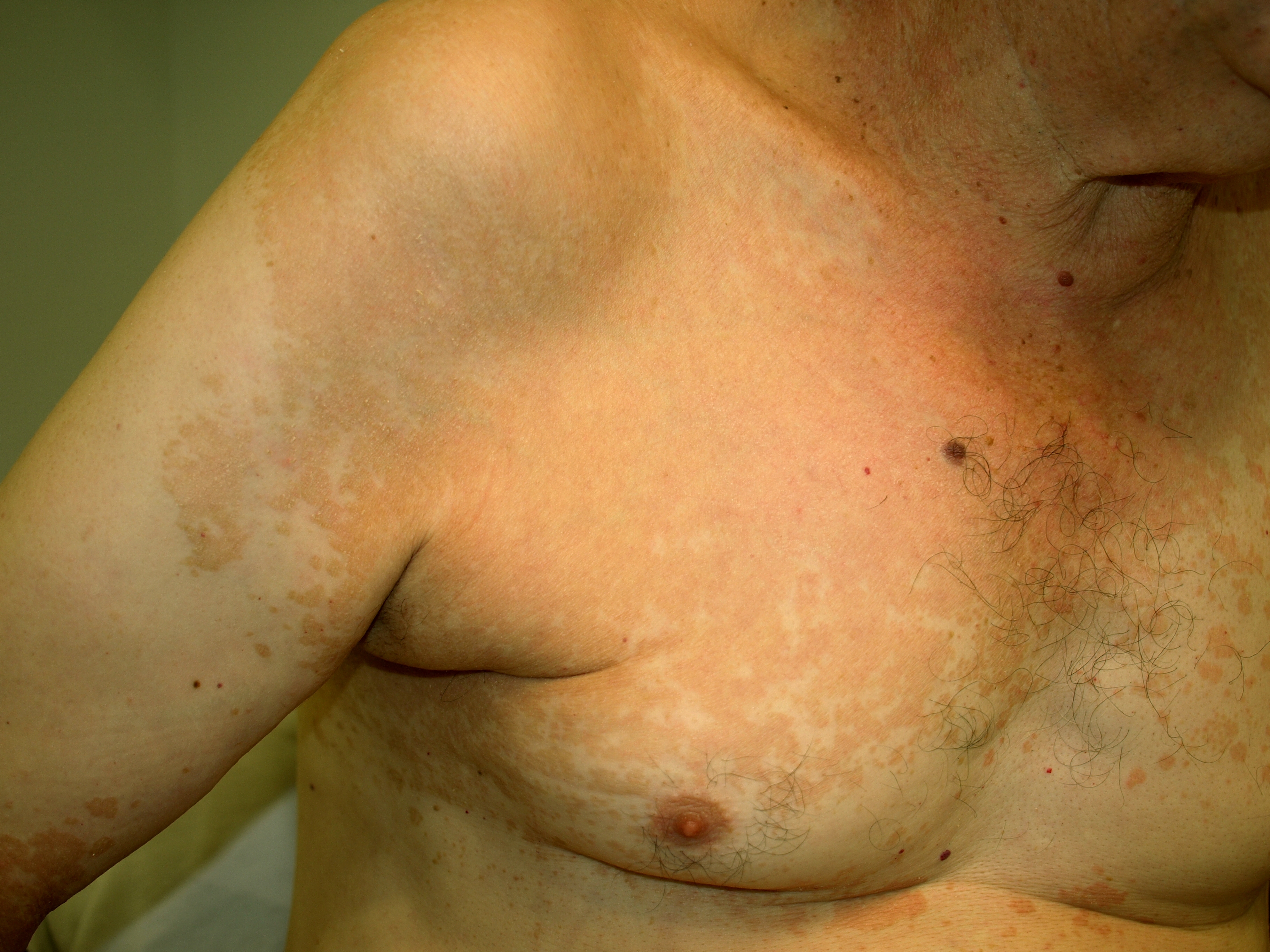 File:Tinea.jpg - Wikimedia Commons