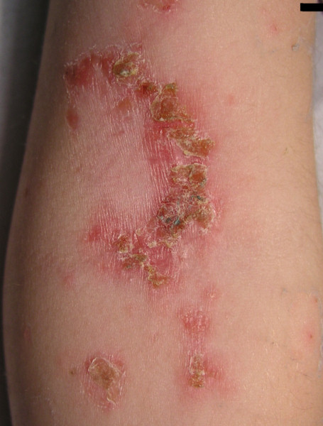File:Impetigo elbow.jpg - Wikimedia Commons