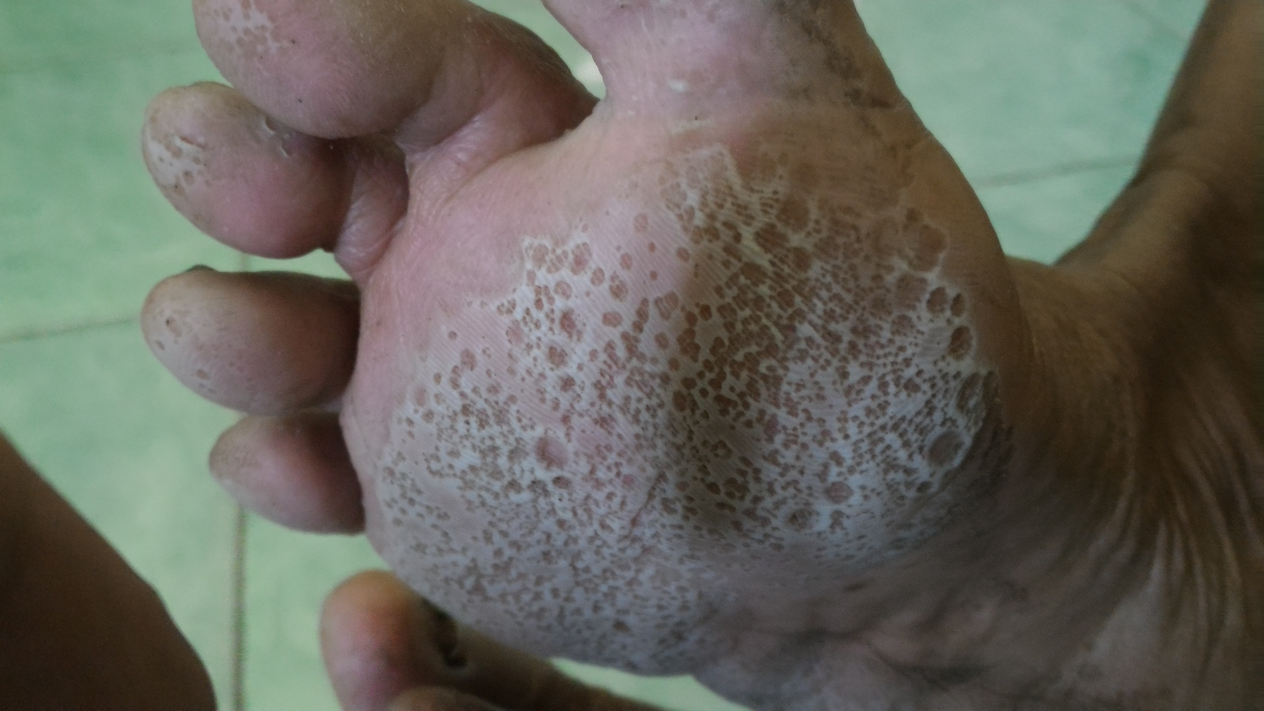 File:Pitted keratolysis 1.jpg - Wikimedia Commons