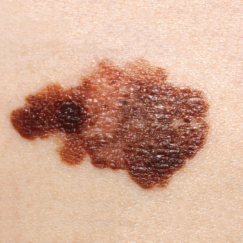 File:519 Melanoma.jpg - Wikimedia Commons