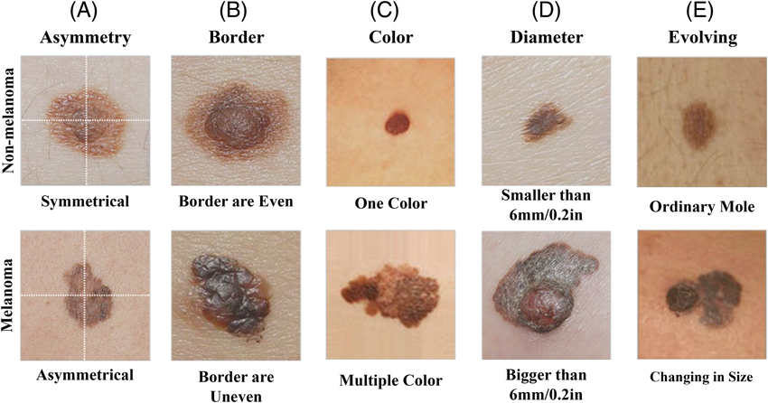 Illustration of ABCDE criteria for skin cancer detection | Download  Scientific Diagram