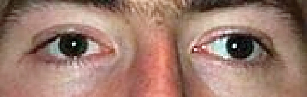 Exotropia in the left eye. | The light reflex is central in … | Flickr