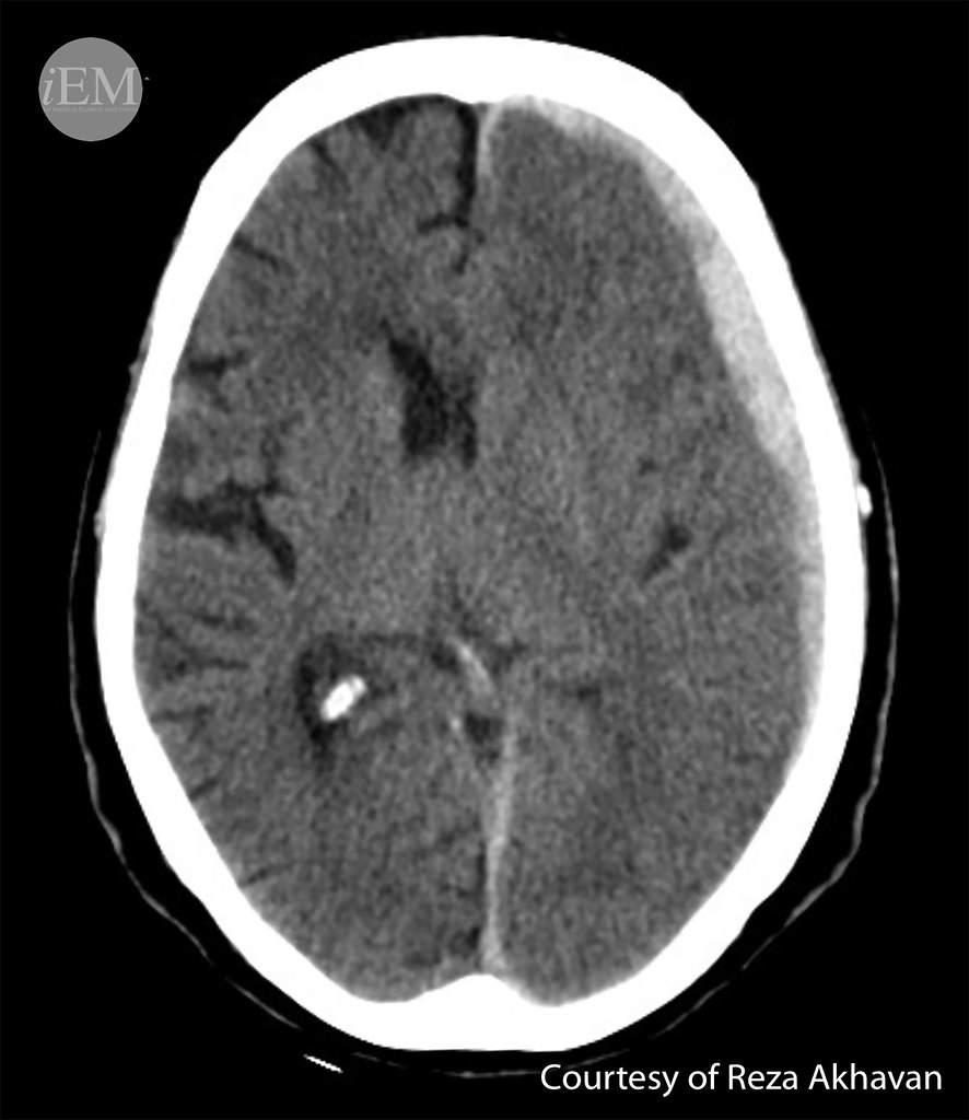 627.17 - Figure - 17 - acute SDH in the left hemisphere wi… | Flickr