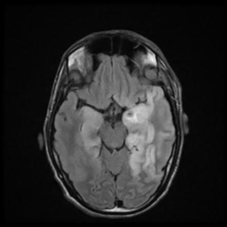 Herpes simplex encephalitis | Radiology Case | Radiopaedia.org