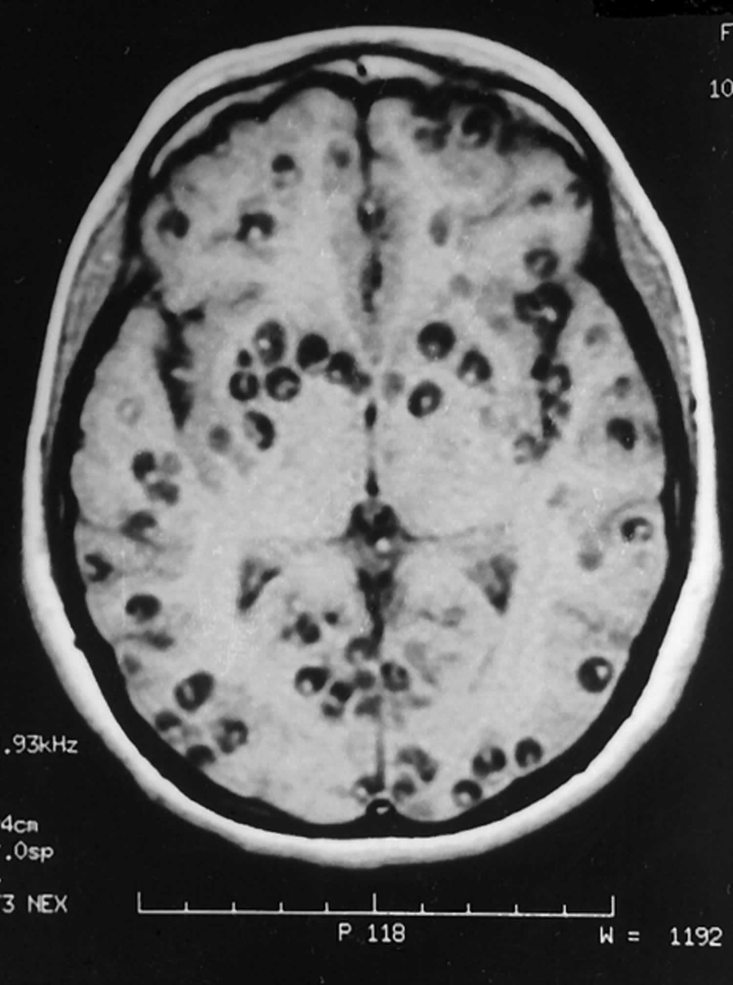 neurocysticercosis