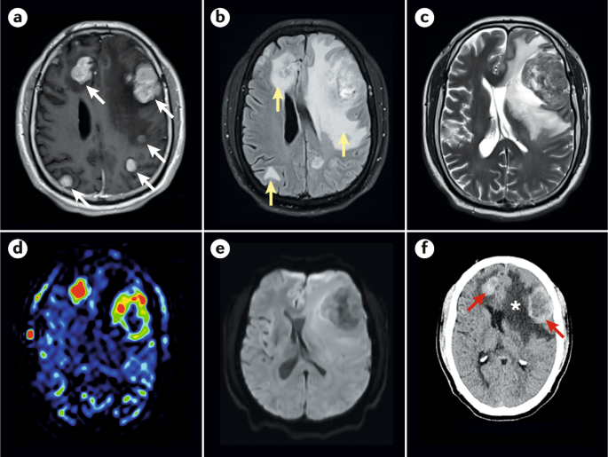 Brain metastases | Nature Reviews Disease Primers