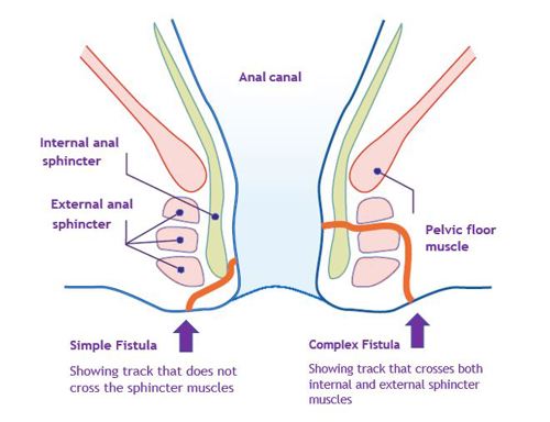 What life with a fistula is really like