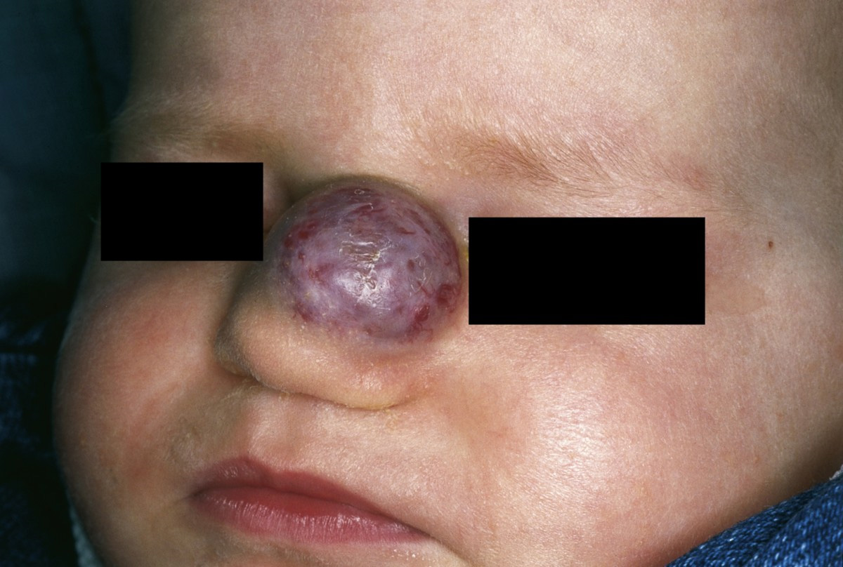File:Hemangioma 01.jpg - Wikimedia Commons