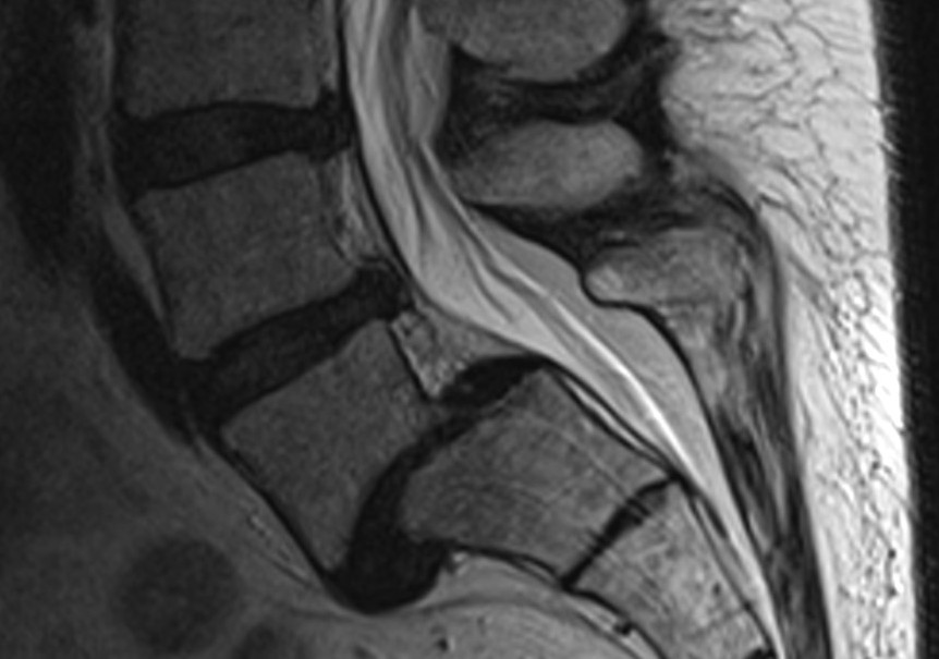 File:MR LWS Spondylolistesis Rueckenmarkskanal.jpg - Wikimedia Commons