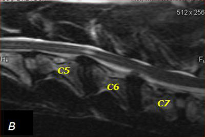 File:Doberman C6-C7 and C5-C6 traction responsive myelopathy B.jpg -  Wikimedia Commons