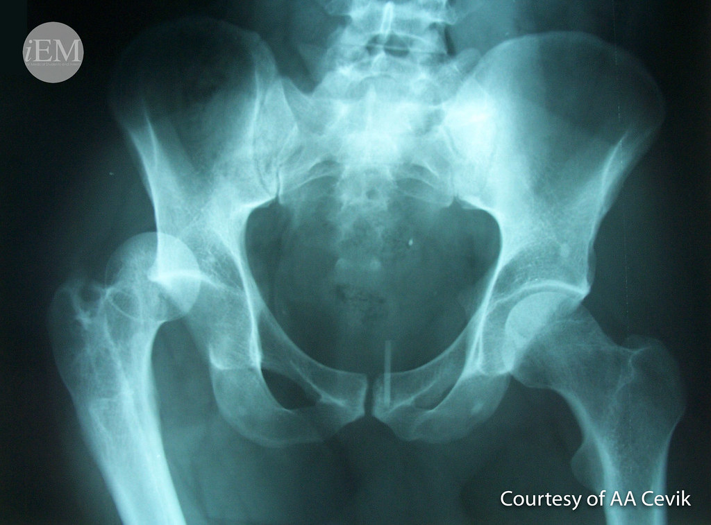 602 - Right hip dislocation | Emergency Medicine Clinical Images and Videos  | Flickr