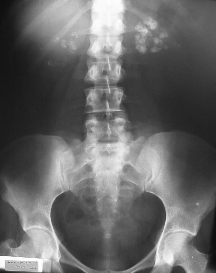 File:Nefrocalcinosis 2.jpg - Wikimedia Commons