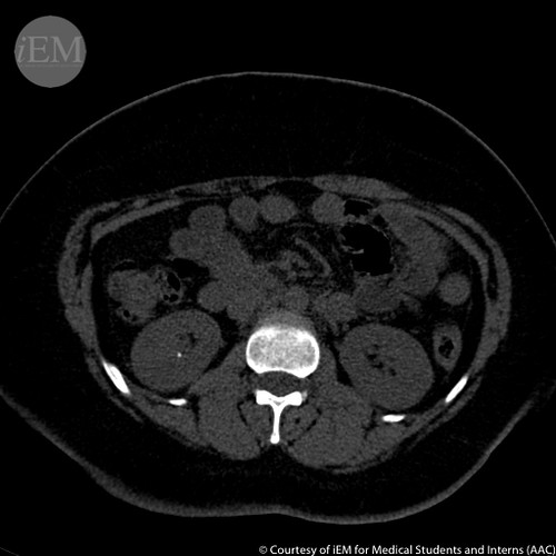 411 - renal stone right CT | CT image of renal stone on the … | Flickr