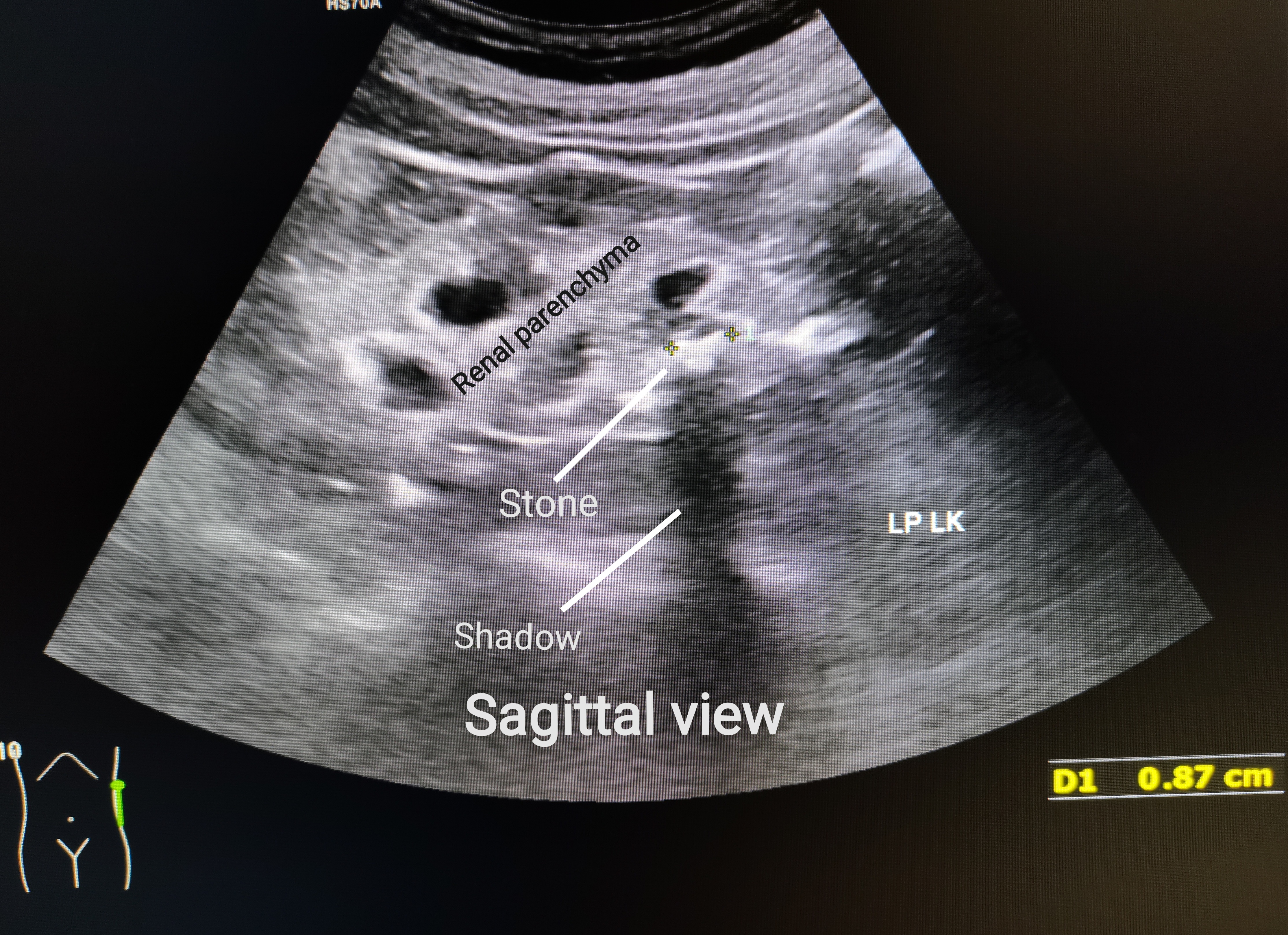 File:Ultrasound of left kidney lower pole with stone.jpg - Wikimedia Commons