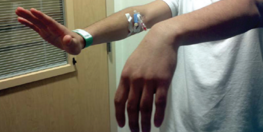 palsy