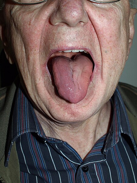 File:Hypoglossal paralysis.jpg