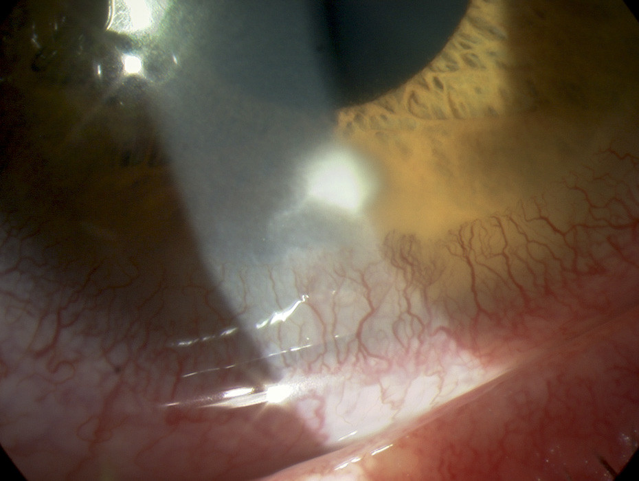 Marginal keratitis | © Matthew Burton Published in: Communit… | Flickr