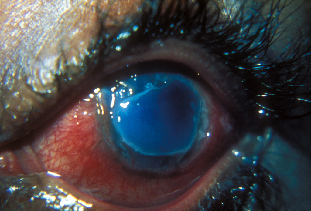Mooren's ulcer. | Red painful eye with 360 degree peripheral… | Flickr