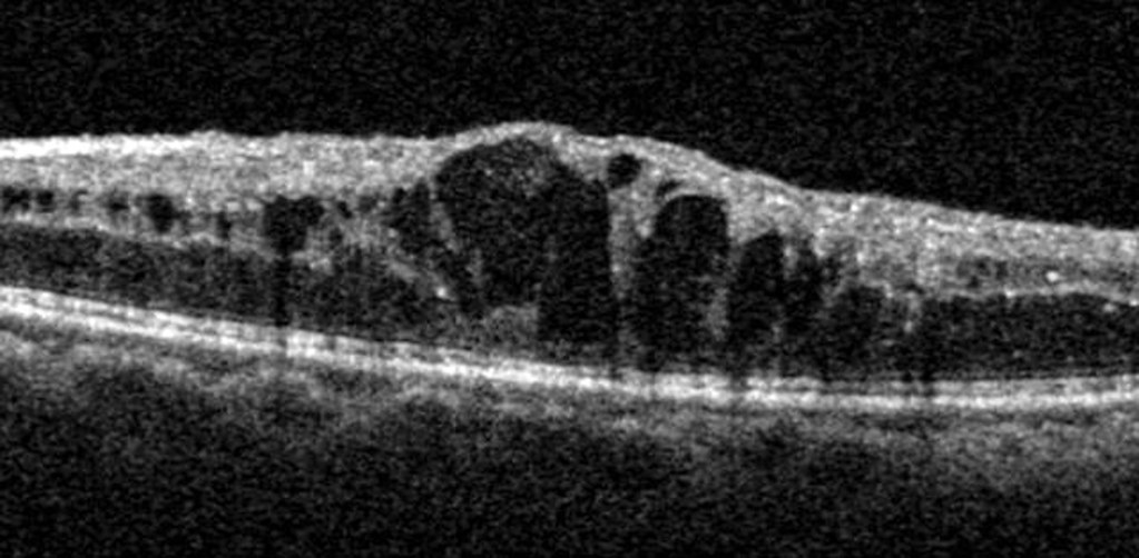 An optical coherence tomography (OCT) image of cystoid mac… | Flickr
