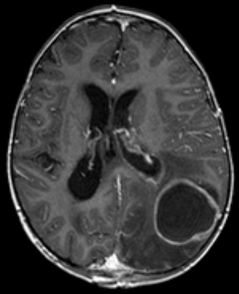 File:Brain abscess - MRI T1 KM axial.jpg - Wikimedia Commons