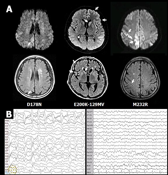 File:CJD profiles of MRI and EEG from probable CJD patient.jpg