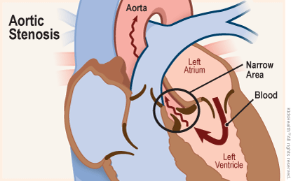 Aortic Stenosis (for Parents) | Nemours KidsHealth