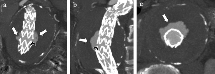 CT angiography for the assessment of EVAR complications: a pictorial review  | Insights into Imaging | Full Text