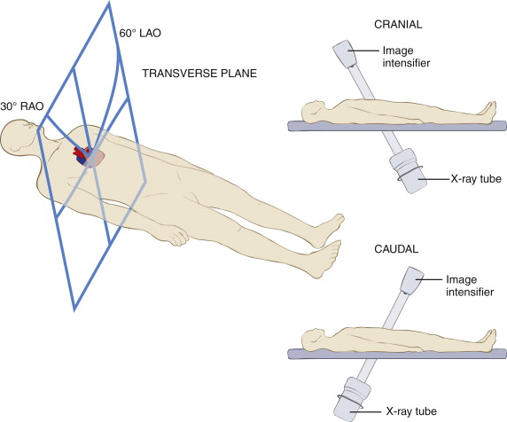 Cardiac Anatomy on Coronary Angiography | Radiology Key