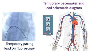 What is temporary pacing? - All About Heart And Blood Vessels