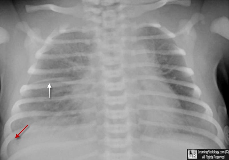LearningRadiology - Transient, tachypnea, newborn, ttn