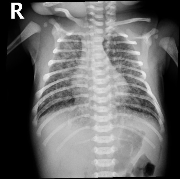 Meconium aspiration | Radiology Case | Radiopaedia.org