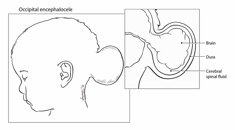 Encephalocele: Symptoms, Diagnosis, Treatment and What to Expect |  Nationwide Children's Hospital